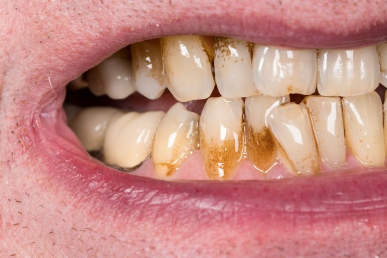 Cavity Vs Stain ContrastHub