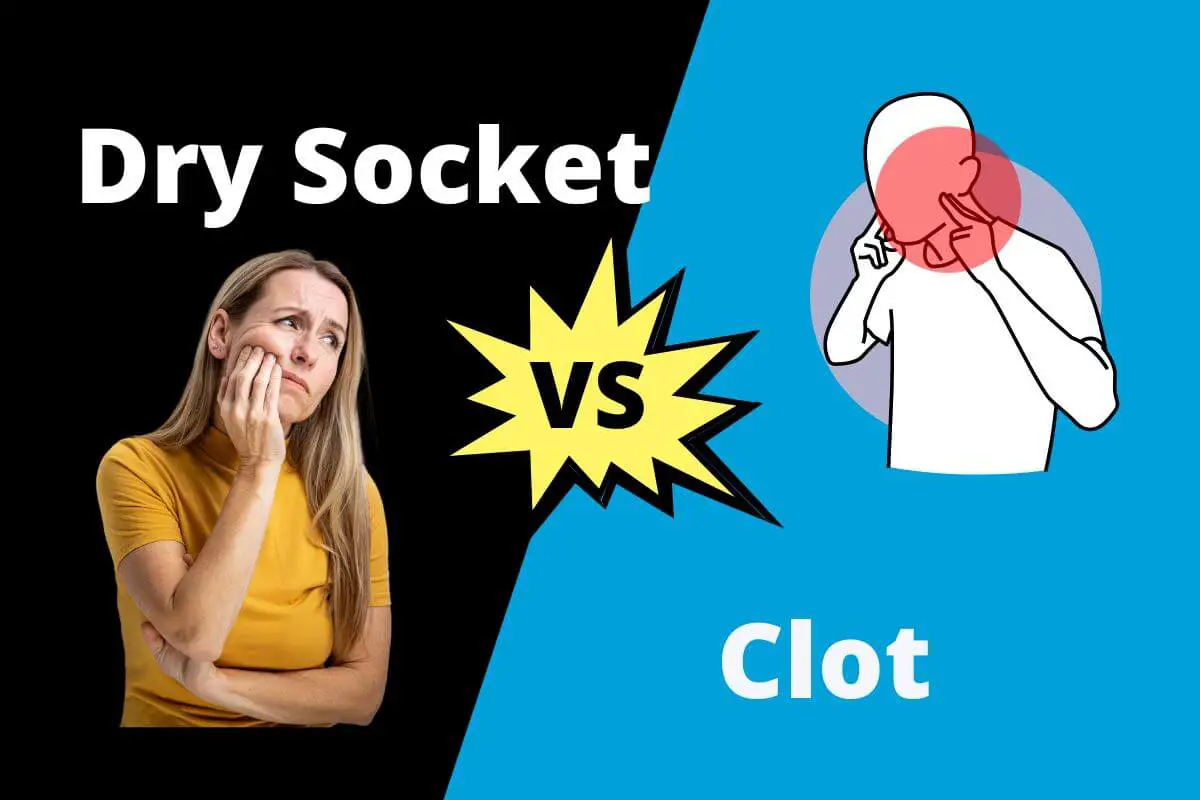 Dry socket vs clot: Learn the differences between these two terms