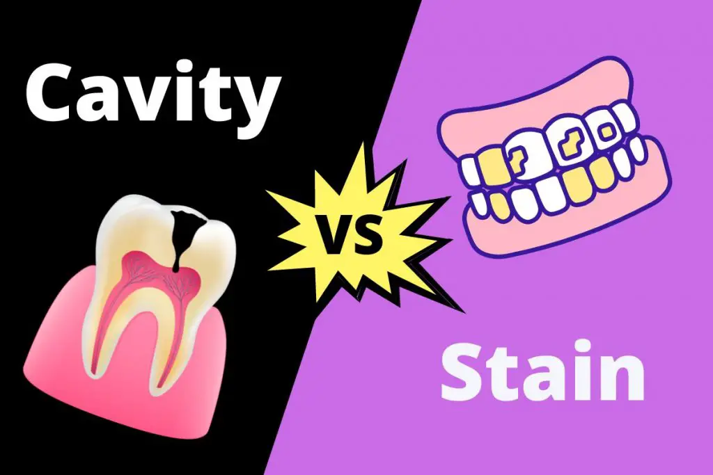 Cavity Vs Stain | ContrastHub